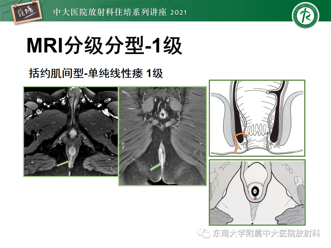 影像PPT - 【PPT】肛瘘的影像诊断及评估-28