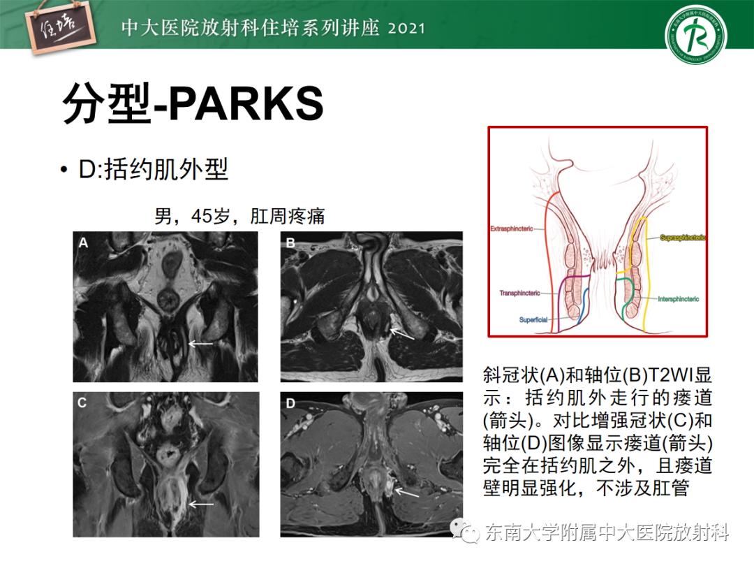 影像PPT - 【PPT】肛瘘的影像诊断及评估-24