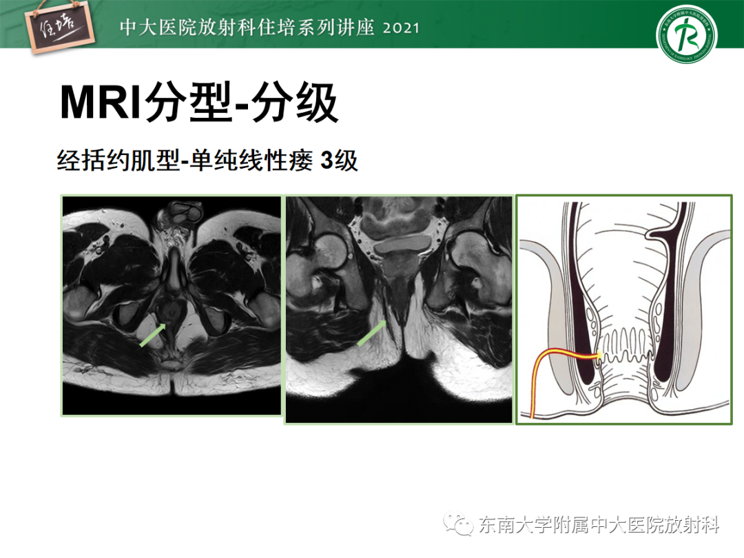 影像PPT - 【PPT】肛瘘的影像诊断及评估-30
