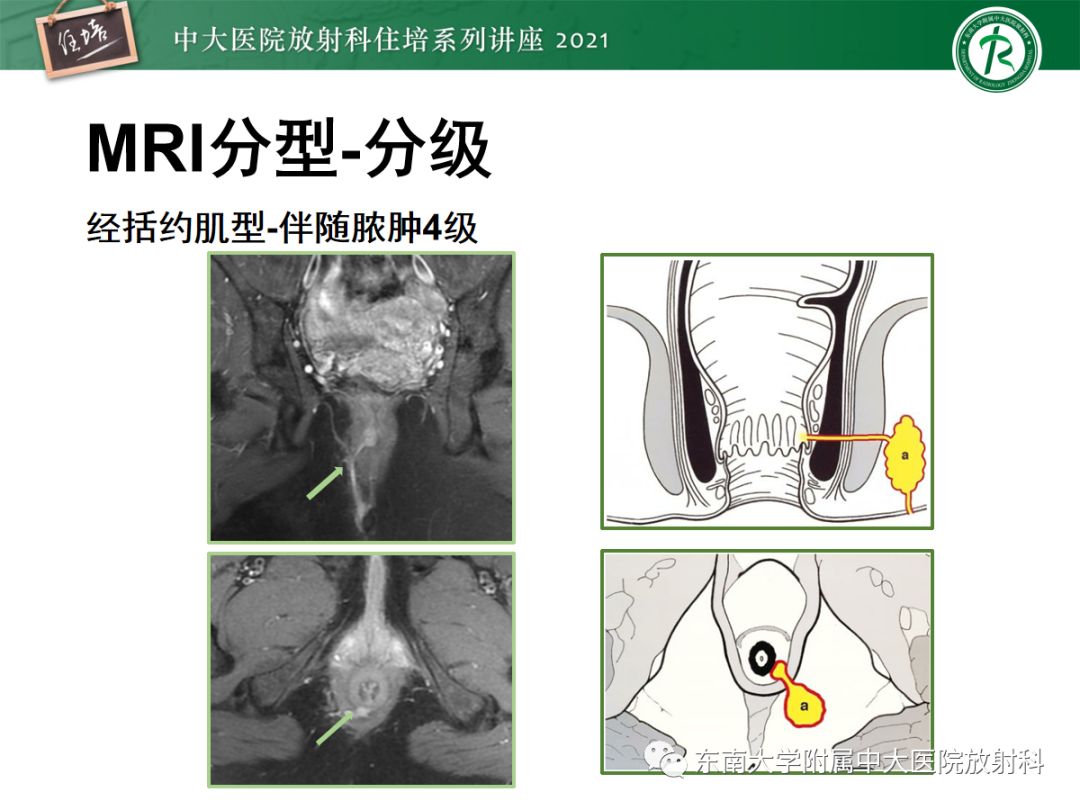 影像PPT - 【PPT】肛瘘的影像诊断及评估-31