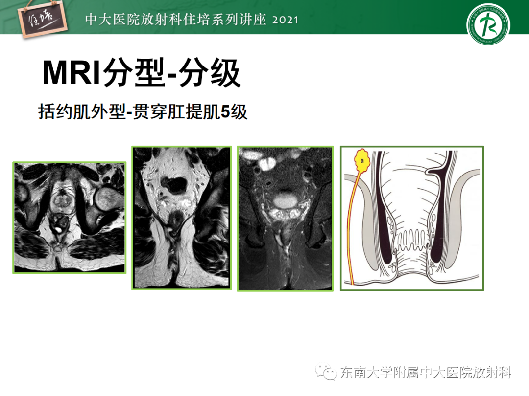 影像PPT - 【PPT】肛瘘的影像诊断及评估-32