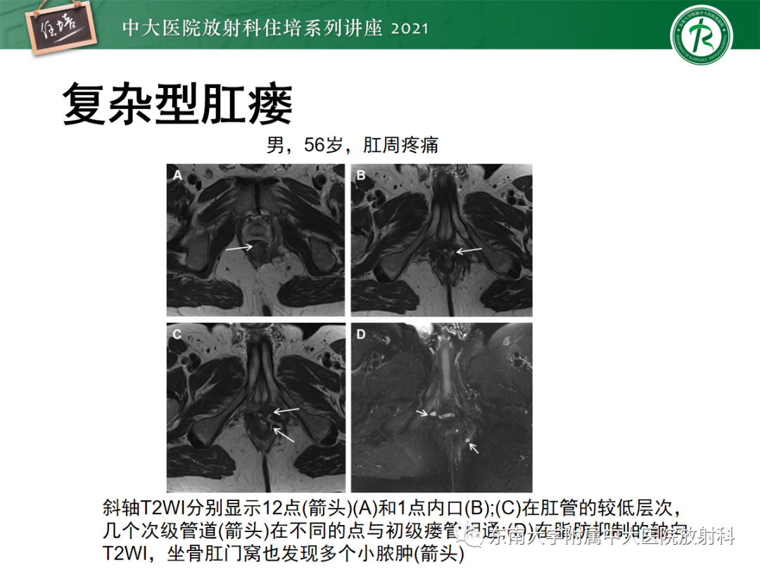 影像PPT - 【PPT】肛瘘的影像诊断及评估-34