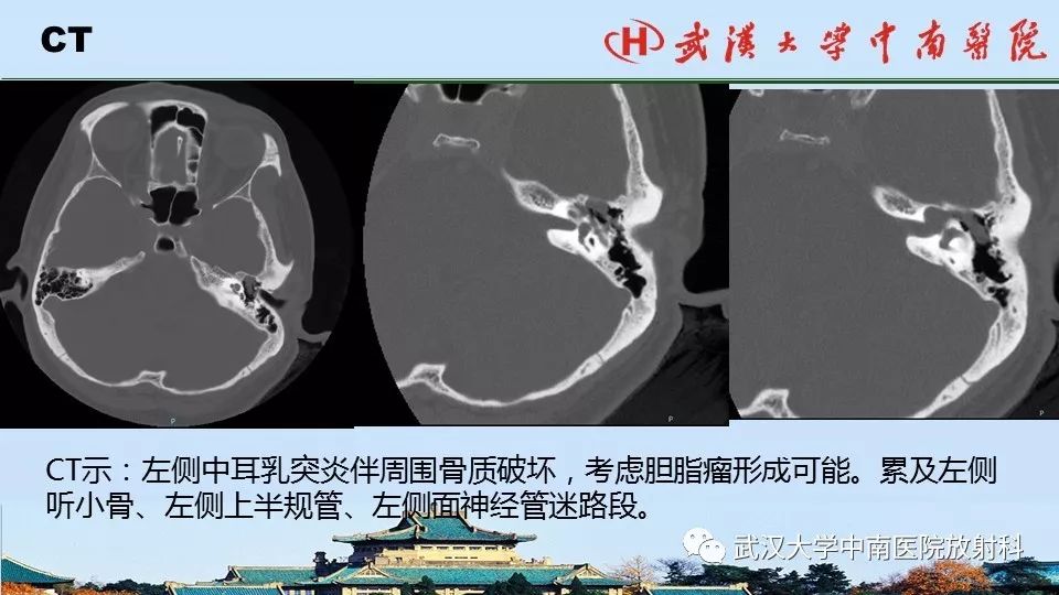 影像PPT - 【病例】中耳胆脂瘤1例CT及MR影像诊断与鉴别-4