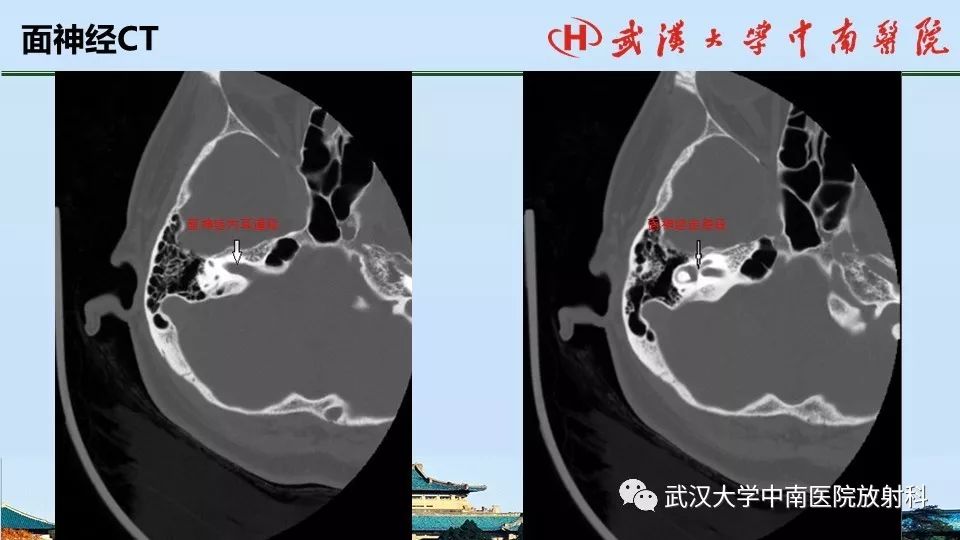 影像PPT - 【病例】中耳胆脂瘤1例CT及MR影像诊断与鉴别-12
