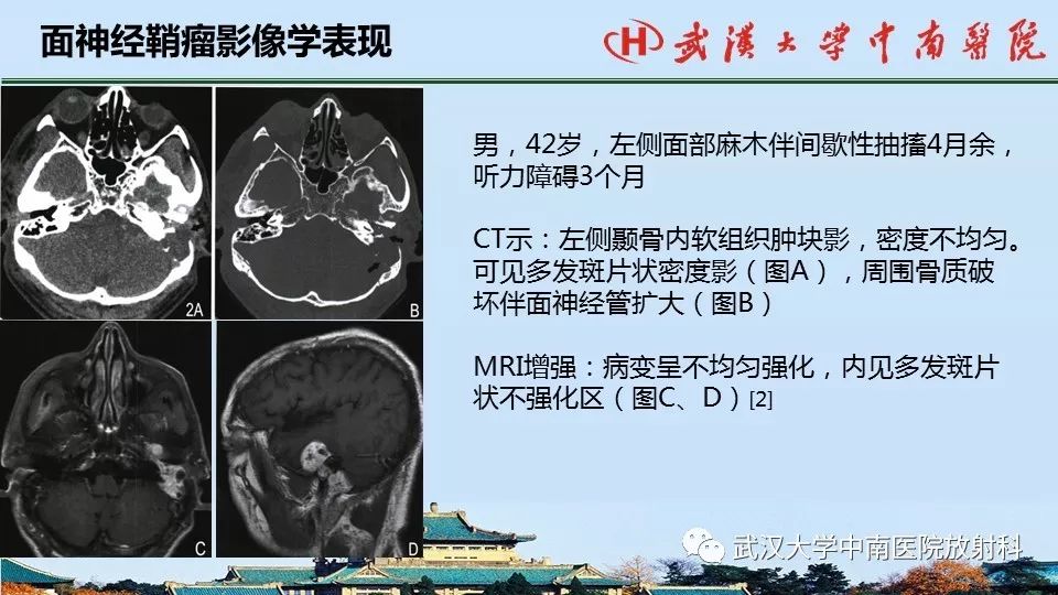 影像PPT - 【病例】中耳胆脂瘤1例CT及MR影像诊断与鉴别-15