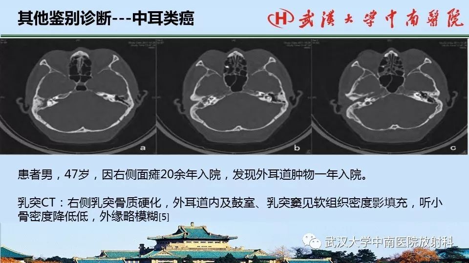 影像PPT - 【病例】中耳胆脂瘤1例CT及MR影像诊断与鉴别-17