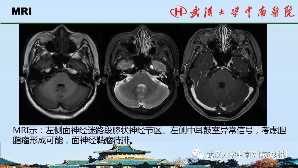 影像PPT - 【病例】中耳胆脂瘤1例CT及MR影像诊断与鉴别-5