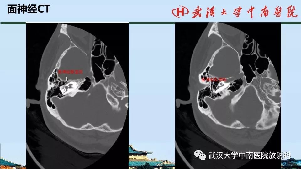 影像PPT - 【病例】中耳胆脂瘤1例CT及MR影像诊断与鉴别-13