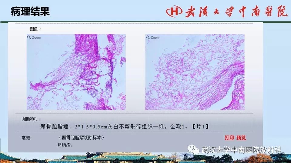 影像PPT - 【病例】中耳胆脂瘤1例CT及MR影像诊断与鉴别-20