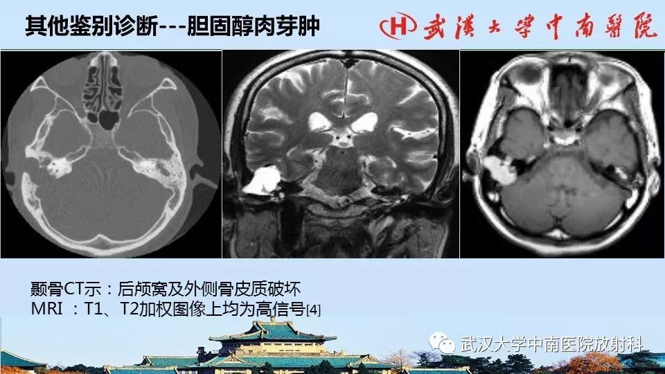 影像PPT - 【病例】中耳胆脂瘤1例CT及MR影像诊断与鉴别-16