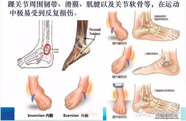 影像PPT - 【PPT】踝关节常见损伤的影像诊断-3