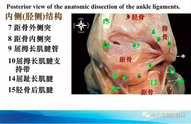 影像PPT - 【PPT】踝关节常见损伤的影像诊断-5