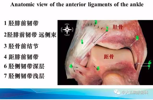 影像PPT - 【PPT】踝关节常见损伤的影像诊断-6