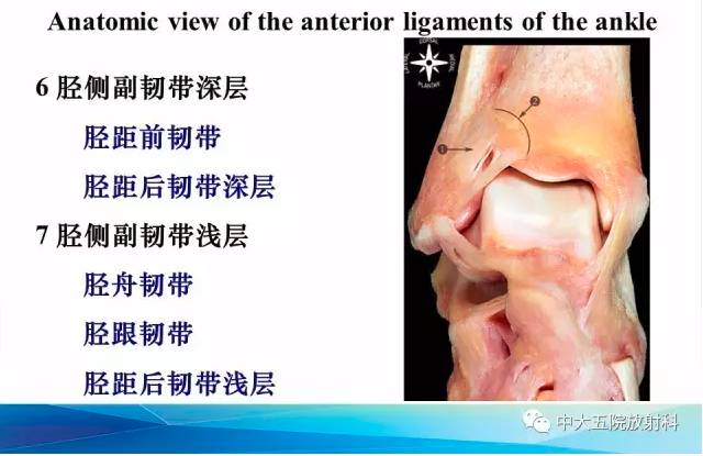 影像PPT - 【PPT】踝关节常见损伤的影像诊断-7