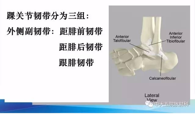 影像PPT - 【PPT】踝关节常见损伤的影像诊断-9