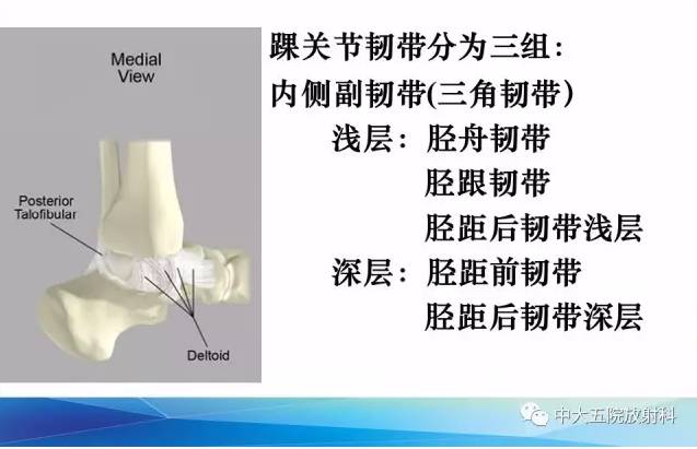 影像PPT - 【PPT】踝关节常见损伤的影像诊断-10