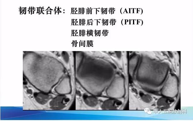 影像PPT - 【PPT】踝关节常见损伤的影像诊断-12