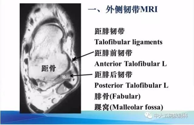 影像PPT - 【PPT】踝关节常见损伤的影像诊断-13