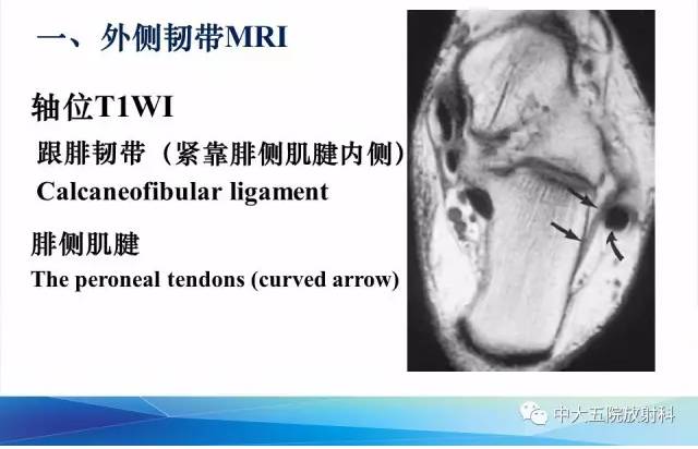 影像PPT - 【PPT】踝关节常见损伤的影像诊断-15
