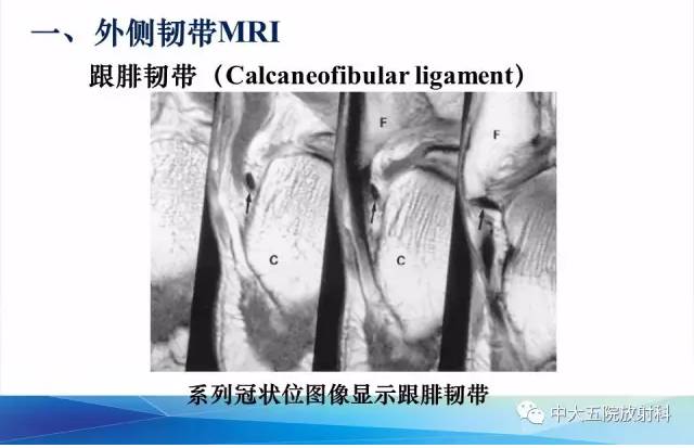 影像PPT - 【PPT】踝关节常见损伤的影像诊断-16