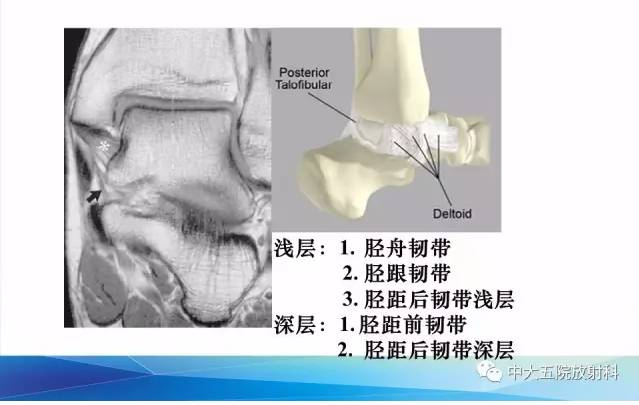 影像PPT - 【PPT】踝关节常见损伤的影像诊断-18