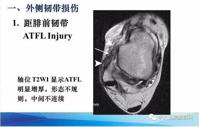 影像PPT - 【PPT】踝关节常见损伤的影像诊断-24