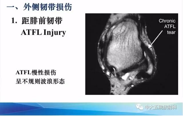 影像PPT - 【PPT】踝关节常见损伤的影像诊断-26