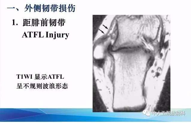 影像PPT - 【PPT】踝关节常见损伤的影像诊断-25