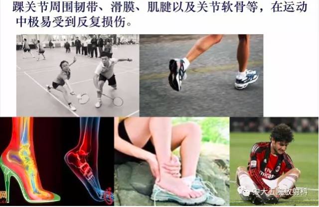 影像PPT - 【PPT】踝关节常见损伤的影像诊断-2