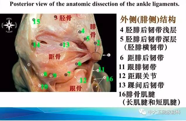 影像PPT - 【PPT】踝关节常见损伤的影像诊断-4