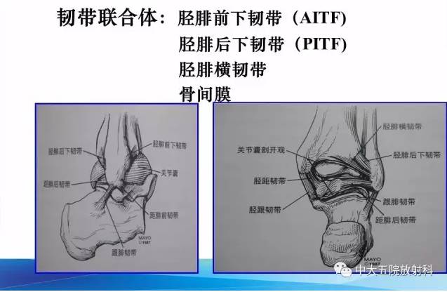 影像PPT - 【PPT】踝关节常见损伤的影像诊断-11