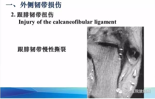 影像PPT - 【PPT】踝关节常见损伤的影像诊断-28