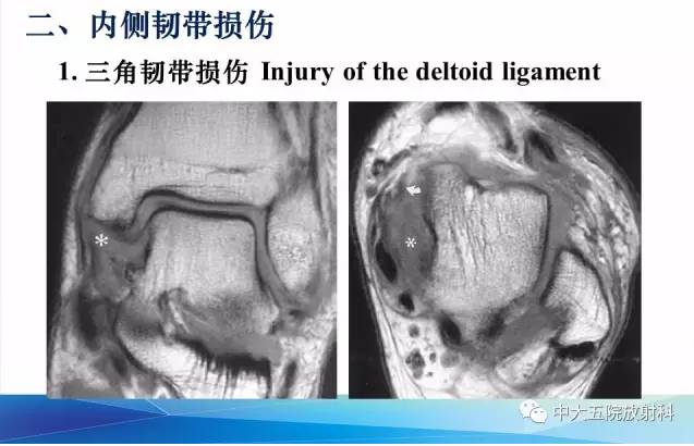 影像PPT - 【PPT】踝关节常见损伤的影像诊断-29