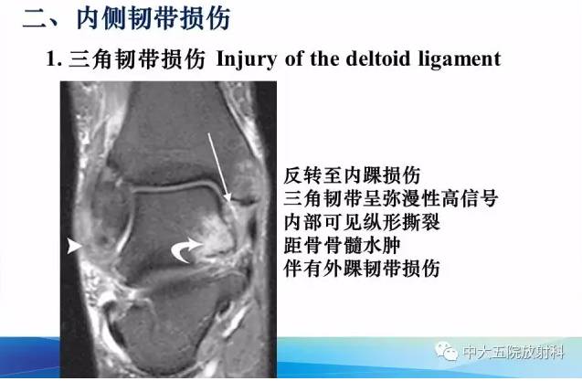 影像PPT - 【PPT】踝关节常见损伤的影像诊断-30