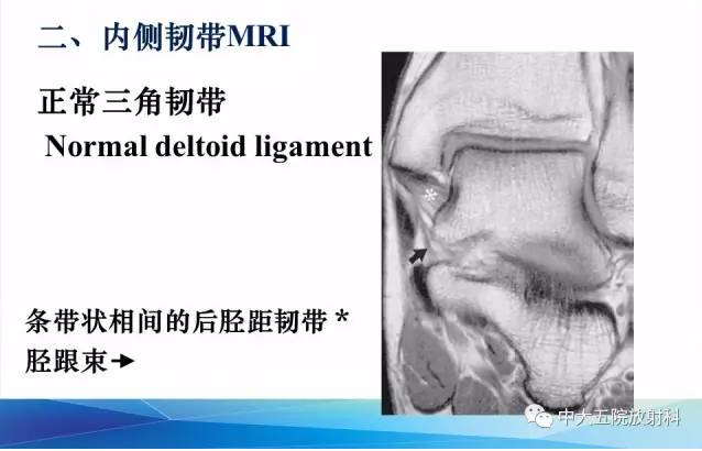 影像PPT - 【PPT】踝关节常见损伤的影像诊断-17