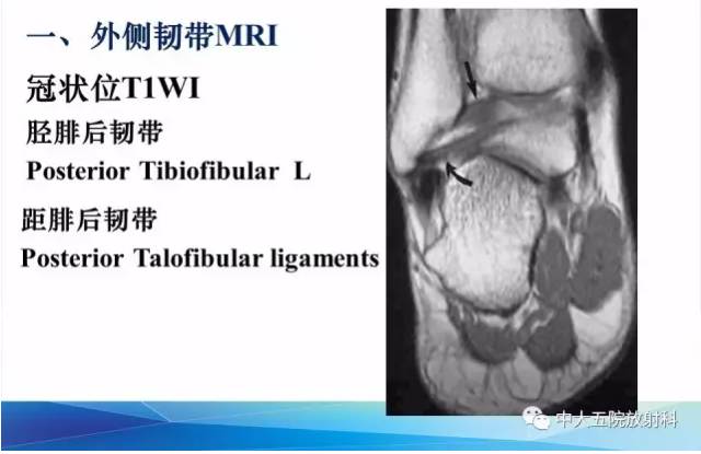 影像PPT - 【PPT】踝关节常见损伤的影像诊断-14