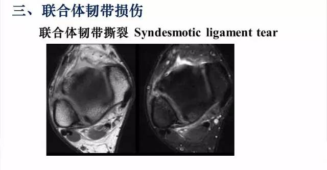 影像PPT - 【PPT】踝关节常见损伤的影像诊断-32