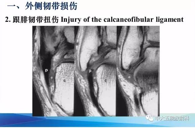 影像PPT - 【PPT】踝关节常见损伤的影像诊断-27