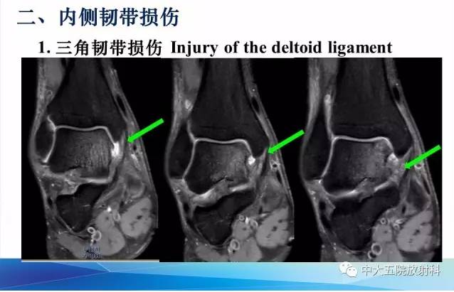 影像PPT - 【PPT】踝关节常见损伤的影像诊断-31