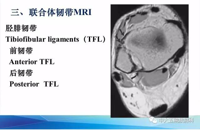 影像PPT - 【PPT】踝关节常见损伤的影像诊断-19
