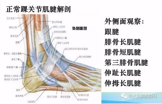 影像PPT - 【PPT】踝关节常见损伤的影像诊断-34