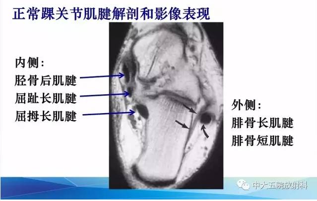 影像PPT - 【PPT】踝关节常见损伤的影像诊断-38