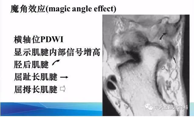 影像PPT - 【PPT】踝关节常见损伤的影像诊断-37