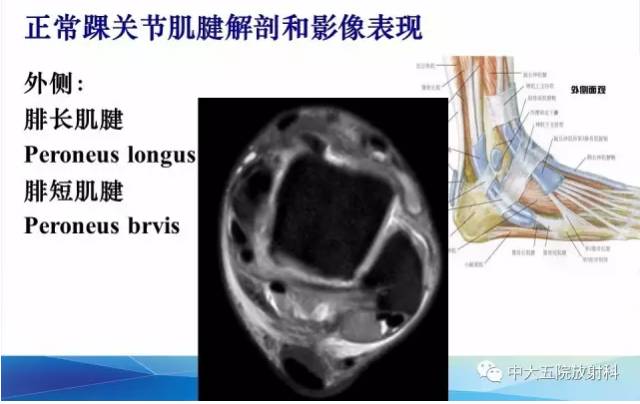 影像PPT - 【PPT】踝关节常见损伤的影像诊断-39