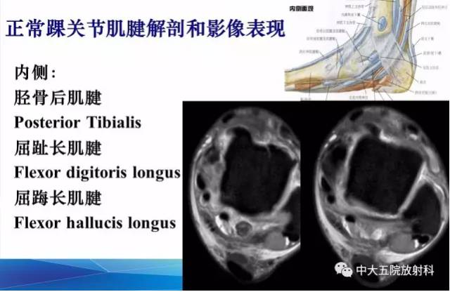 影像PPT - 【PPT】踝关节常见损伤的影像诊断-40