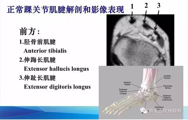 影像PPT - 【PPT】踝关节常见损伤的影像诊断-41