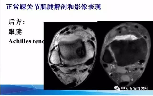 影像PPT - 【PPT】踝关节常见损伤的影像诊断-42