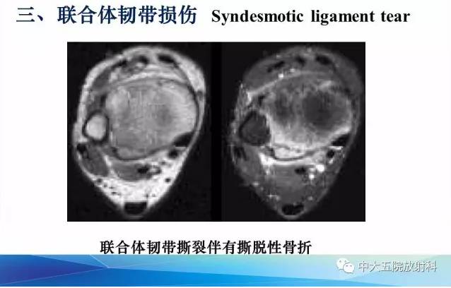 影像PPT - 【PPT】踝关节常见损伤的影像诊断-33