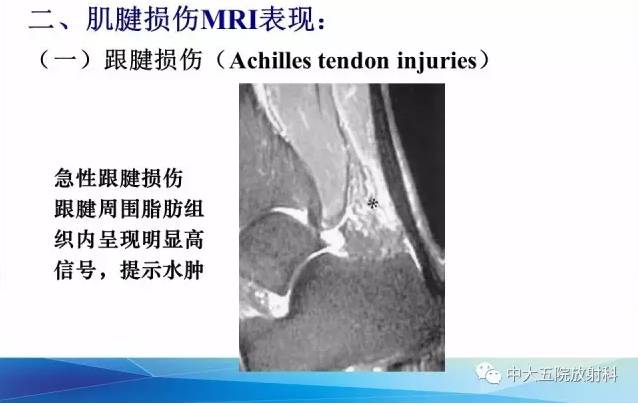 影像PPT - 【PPT】踝关节常见损伤的影像诊断-45