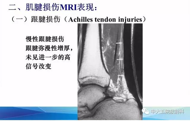 影像PPT - 【PPT】踝关节常见损伤的影像诊断-46